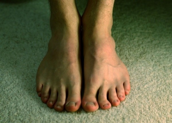 Γιατί ιδρώνουν πολύ τα πόδια μου;