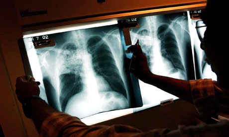 Έντονη ανησυχία για τη φυματίωση στη Βρετανία