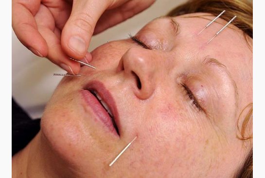 Βελονισμός αντί για λίφτινγκ: Σβήνει τις ρυτίδες