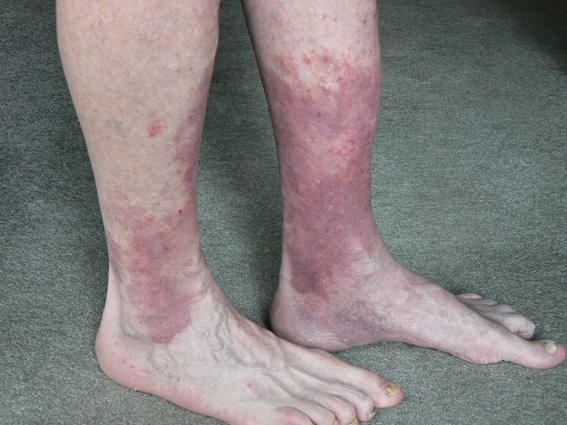 Κακή κυκλοφορία αίματος: Ποια σημάδια να προσέχεις