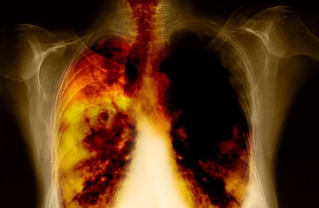 Καρκίνος του πνεύμονα: Νο1 αιτία θανάτου στην Ευρώπη