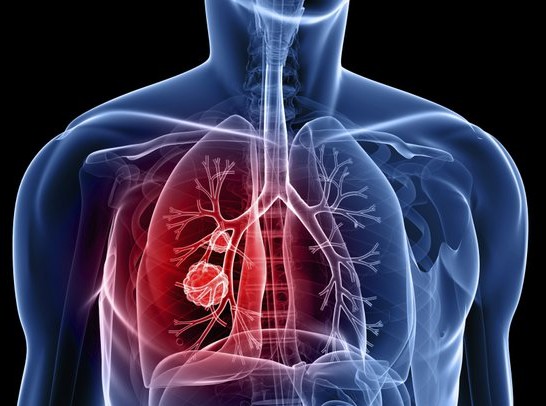 Ο καρκίνος των πνευμόνων θα ξεπεράσει τον καρκίνο του μαστού
