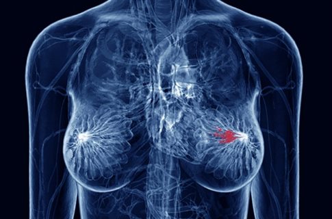 Τα γονίδια που ευθύνονται για τον καρκίνο του μαστού