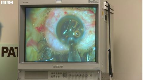 Το “καθημερινό θαύμα” της επέμβασης του καταρράκτη – ΒΙΝΤΕΟ