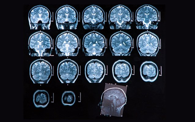 Διατροφή και σκλήρυνση κατά πλάκας