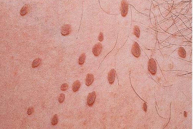 Θηλώματα: Πόσο επικίνδυνα είναι και πως θεραπεύονται