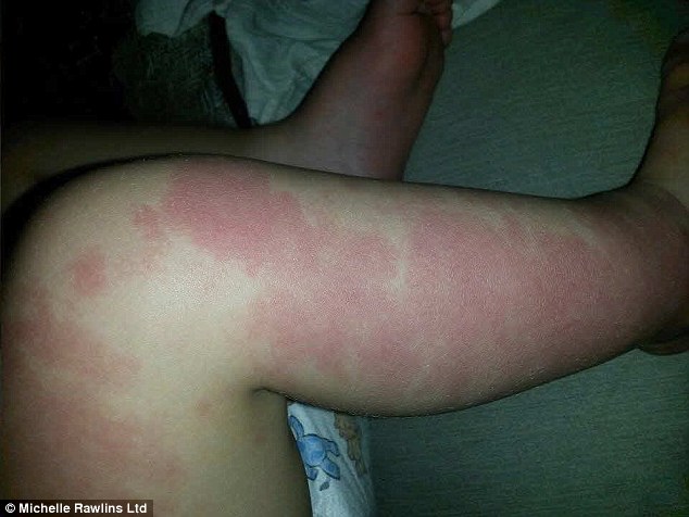 Mark: Honey-Rae's birthmark, pictured, is harmless but caused strangers to whisper at a shop checkout