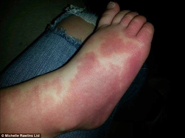 Condition: Known medically as haemangiomas, strawberry birthmarks are an abnormal cluster of blood vessels just under the skin. They affect one in ten babies but most of the time they are completely harmless