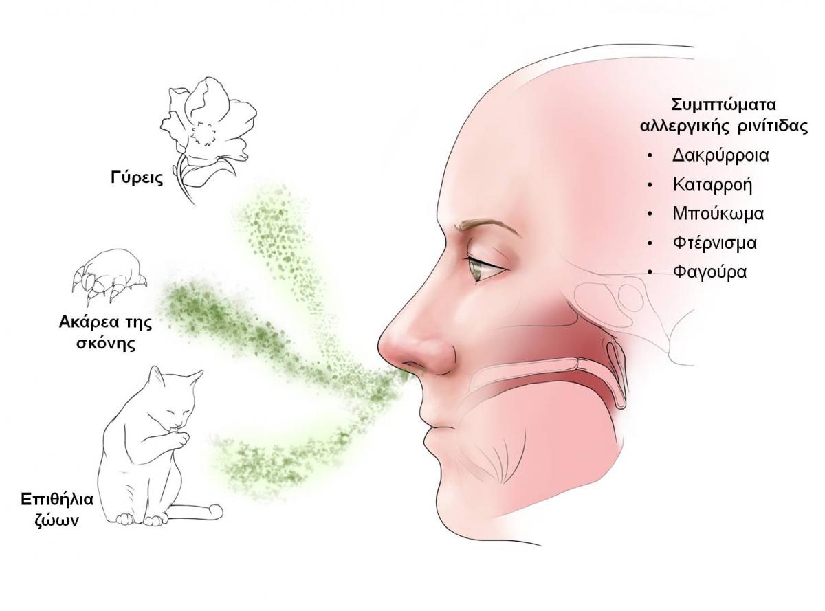 Αλλεργική ρινίτιδα σε παιδιά