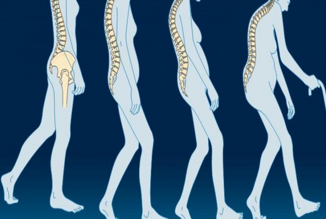 Ασβέστιο και οστεοπόρωση: Μύθοι και αλήθειες