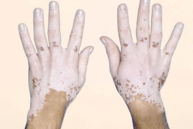 Λεύκη- Συμπτώματα και θεραπεία