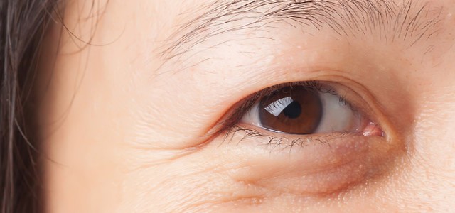 Σακούλες κάτω από τα μάτια- Ποια είναι η θεραπεία