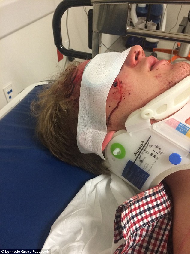 Horrific injuries: A rep for the actor said doctors had to reconstruct the right side of his face but have told Dalton his vision will recover. He also suffered a shattered pelvis and femur in the crash