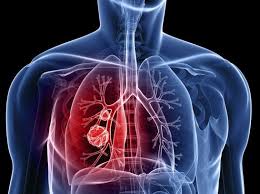 Καρκίνος του πνεύμονα: Δεν αφορά μόνο τους καπνιστές