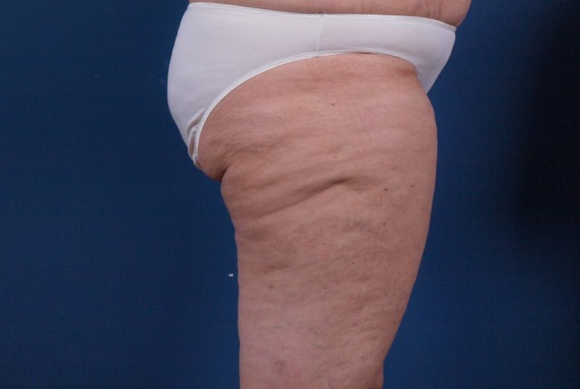 Κυτταρίτιδα- Πώς δημιουργείται και πώς να την αντιμετωπίσεις