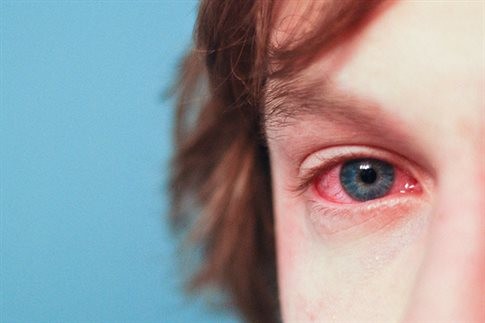 Αλλεργική επιπεφυκίτιδα – Μαστίζει την άνοιξη