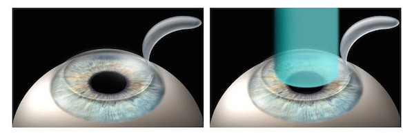 Διόρθωση της μυωπίας με την μέθοδο Lasik