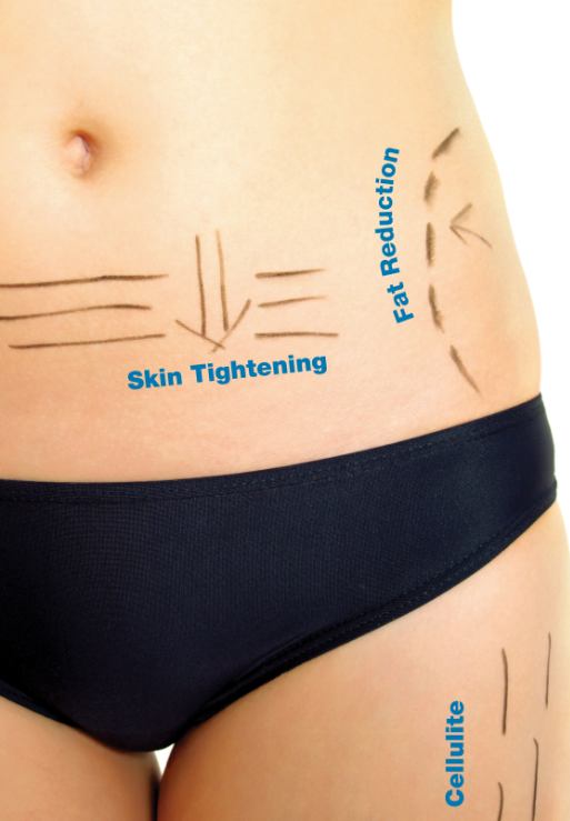 Κρυολιπόλυση με την τεχνολογία 3D-LIPO