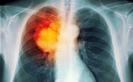 Εγκρίθηκε νέο φάρμακο για τον καρκίνο του πνεύμονα