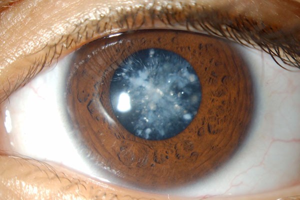 Καταρράκτης – Πως να εμποδίσουμε την εξέλιξή του;