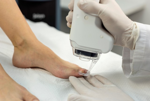 Ονυχομυκητίαση – Σύγχρονες μέθοδοι αντιμετώπισης