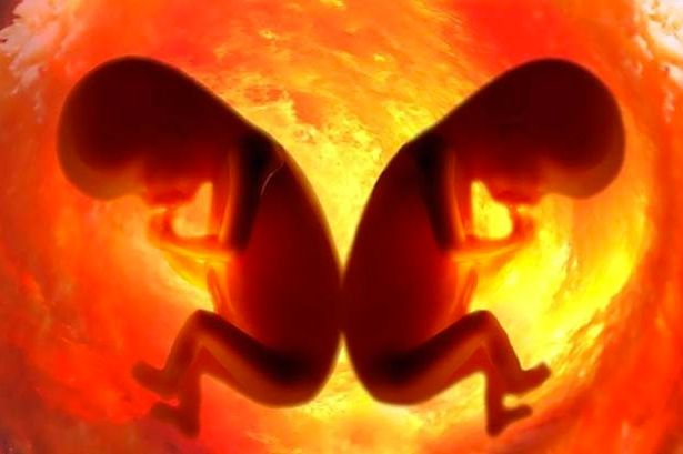 Έφερε στον κόσμο δίδυμα από διαφορετικό πατέρα