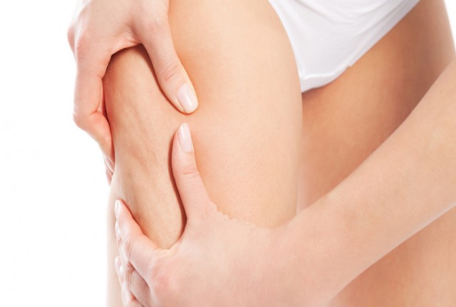 Κυτταρίτιδα – Μάθε τα πάντα για τις επιλογές αντιμετώπισης