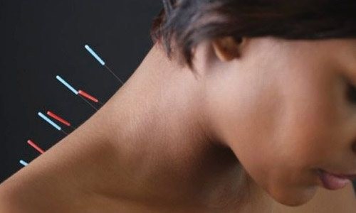 Βελονισμός: Πως βοηθά να ξεπεράσετε ημικρανίες