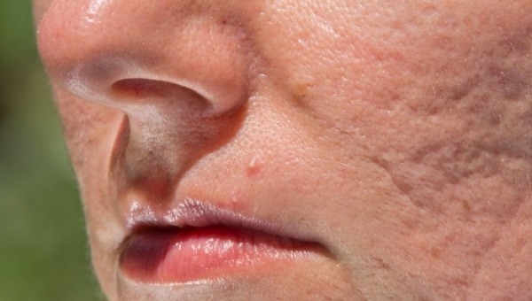 Πως να βελτιώσετε τις ουλές από την ακμή