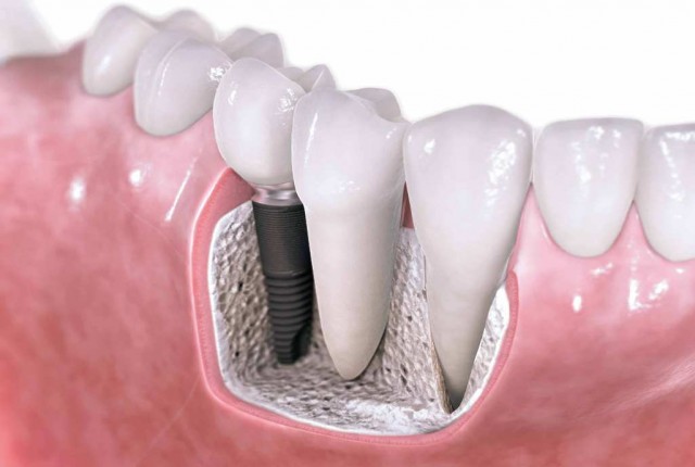 Τα οδοντικά εμφυτεύματα και οι εφαρμογές τους