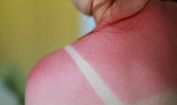 Έγκαυμα από τον ήλιο – Πως να το αντιμετωπίσετε