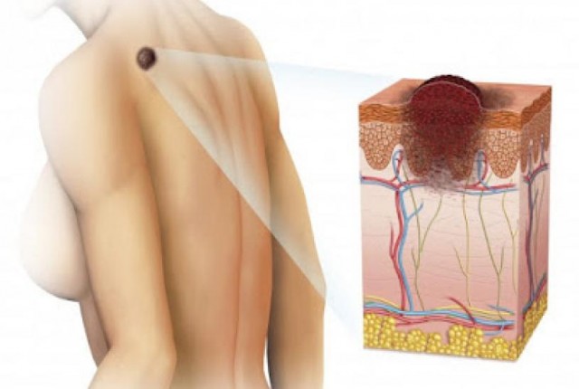 Τα μέτρα πρόληψης από τον καρκίνο του δέρματος