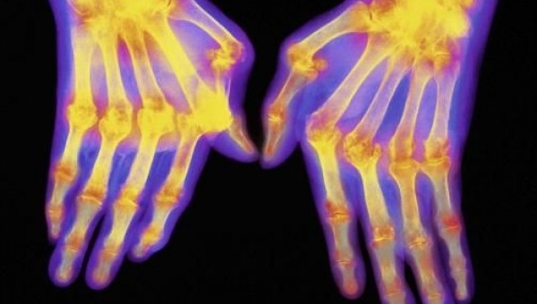 Ρευματοειδής αρθρίτιδα και άσκηση