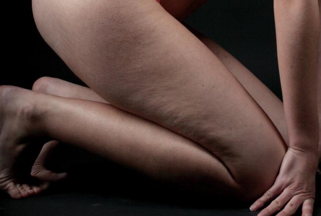 Πως να αντιμετωπίσετε την κυτταρίτιδα