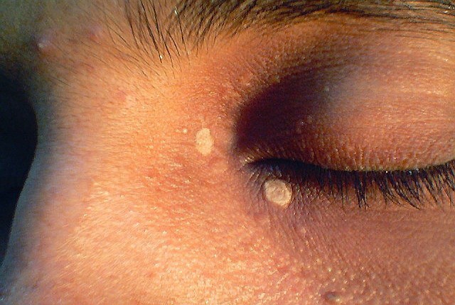 Τα μάτια «δείχνουν» την πιθανότητα εμφράγματος