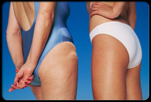 Κυτταρίτιδα και τοπικό πάχος – Θεραπεία για άμεση αντιμετώπιση