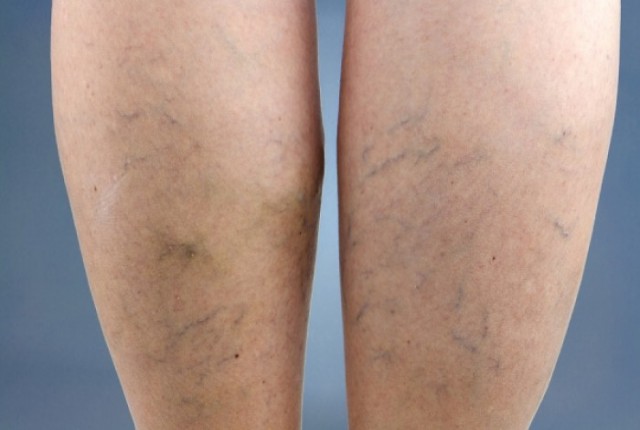 Φλεβική ανεπάρκεια – Συμπτώματα και διάγνωση