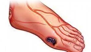 Τι είναι τα έλκη που εμφανίζονται στα πόδια;