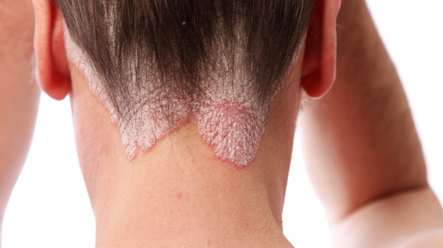 Ψωρίαση- Όλες οι πληροφορίες για την αντιμετώπισή της