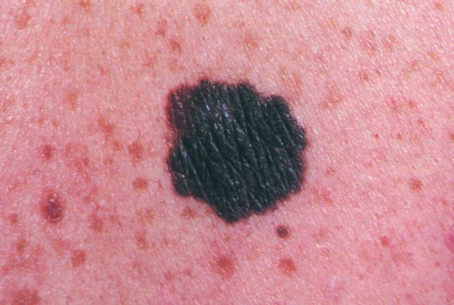 Δερματοσκόπηση ελιών- Μία αναγκαία εξέταση