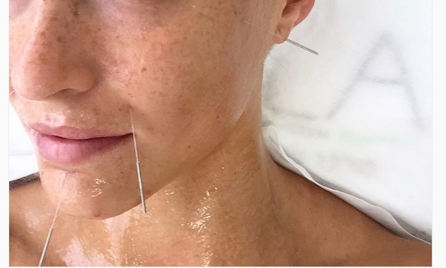 Δείτε γνωστό μοντέλο να κάνει βελονισμό – ΦΩΤΟ