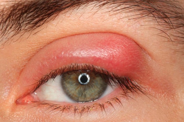 Βλεφαρίτιδα: Μία συχνή φλεγμονή που μας ταλαιπωρεί