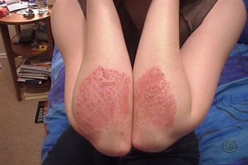 Ψωρίαση- Νέο φάρμακο υπόσχεται στους πάσχοντες καθαρό δέρμα