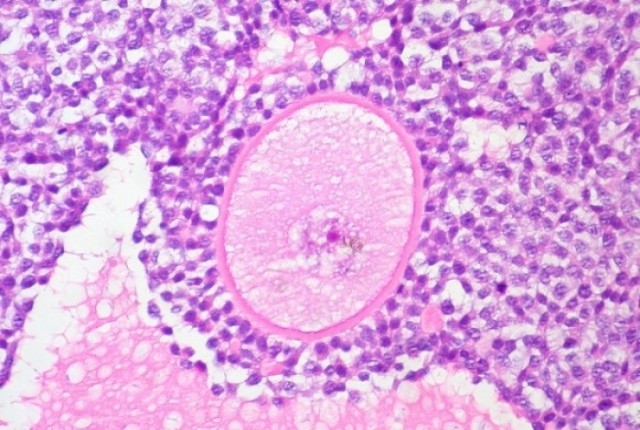 Τα κρυφά σημάδια του καρκίνου των ωοθηκών