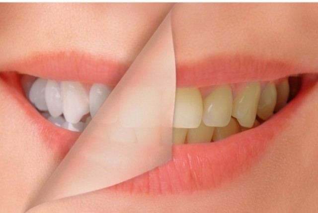 Όλες οι πληροφορίες για τις κακές συνήθειες στα δόντια