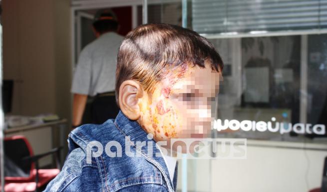 Καταγγελία ΣΟΚ- «Ο πρώην εργοδότης μου έλουσε με καυτό καφέ το 2χρονο εγγονάκι μου»