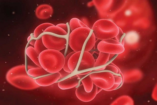 Παγκόσμια ημέρα θρόμβωσης- Γνωρίστε και αντιμετωπίστε τη νόσο