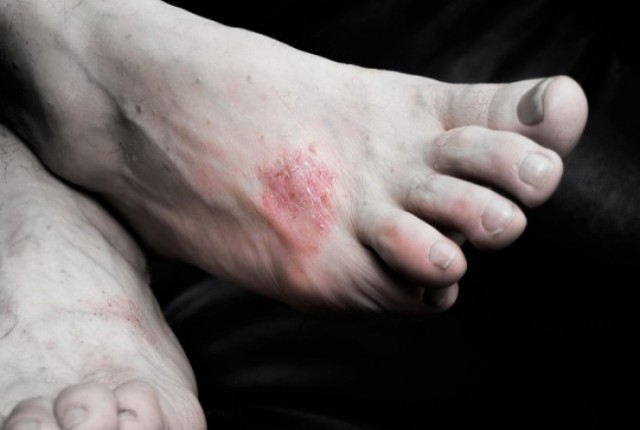 Ασθενείς μιλούν για την ψωρίαση