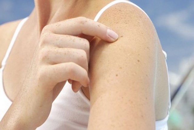 Καρκίνος δέρματος- Μετρήστε τις ελιές στο χέρι σας για να δείτε αν κινδυνεύετε