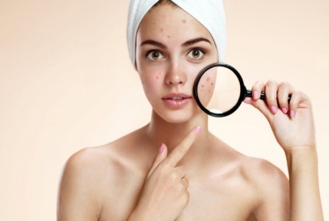 Αλόη- Αντιμετωπίστε τα σπυράκια εύκολα και απλά